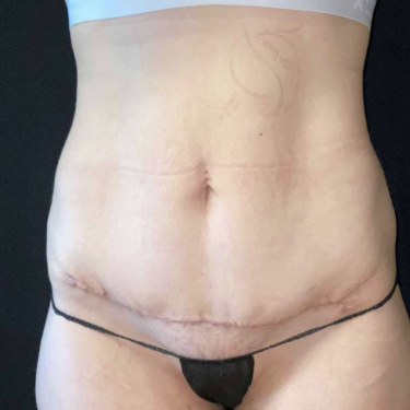 Tummy Tuck in Northern Virginia - Timothy Mountcastle, M.D.