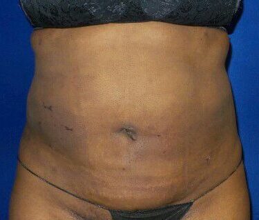 Liposuction - Abdomen / Flanks Before and After Pictures Case 14, Coeur  d'Alene, ID